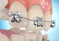 image انجام ارتودنسی دندان کار درستی است یا غلط
