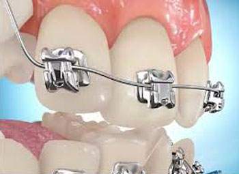 image انجام ارتودنسی دندان کار درستی است یا غلط