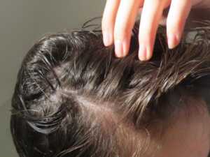 image بهترین درمان برای ریزش مو در زنان
