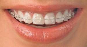 image اگر میخواهید ارتودنسی دندان کنید بخوانید