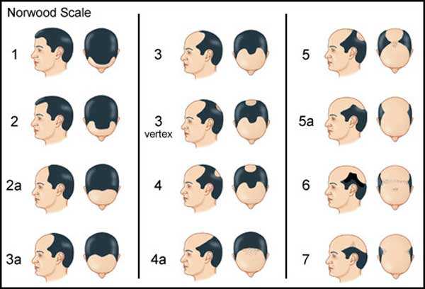 image چه راه هایی برای جلوگیری از ریختن موی سر در مردان وجود دارد