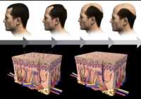 image چه راه هایی برای جلوگیری از ریختن موی سر در مردان وجود دارد