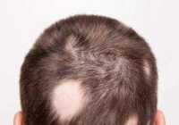 image علت ریزش یک منطقه کوچک از مو چیست و راه درمان آن