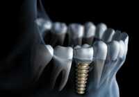 image ایمپلنت یا کاشت دندان چه زمانی لازم است و اطلاعات مفید