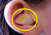image روش خانگی و آسان برای درمان عفونت گوش