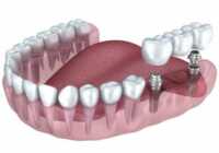 image استفاده از ایمپلنت دندان از چه سنی کاربرد دارد