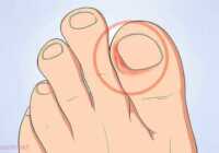 image چطور مشکل فرو رفتن ناخن در شست پا را درمان کنید