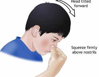 image راهکارهایی برای قطع سریع خونریزی از بینی