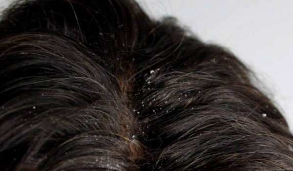 image چرا موهای سر شوره می زند و راه درمان اصلی