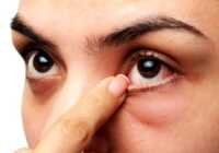 image نشانه ها و نحوه درمان خشکی چشم